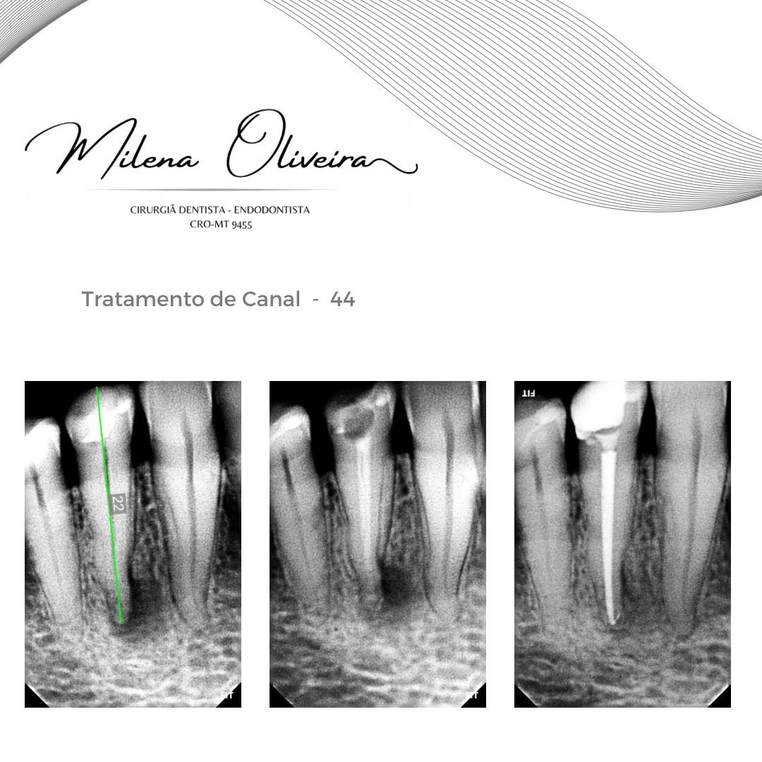 Caso clínico - Tratamento de canal
